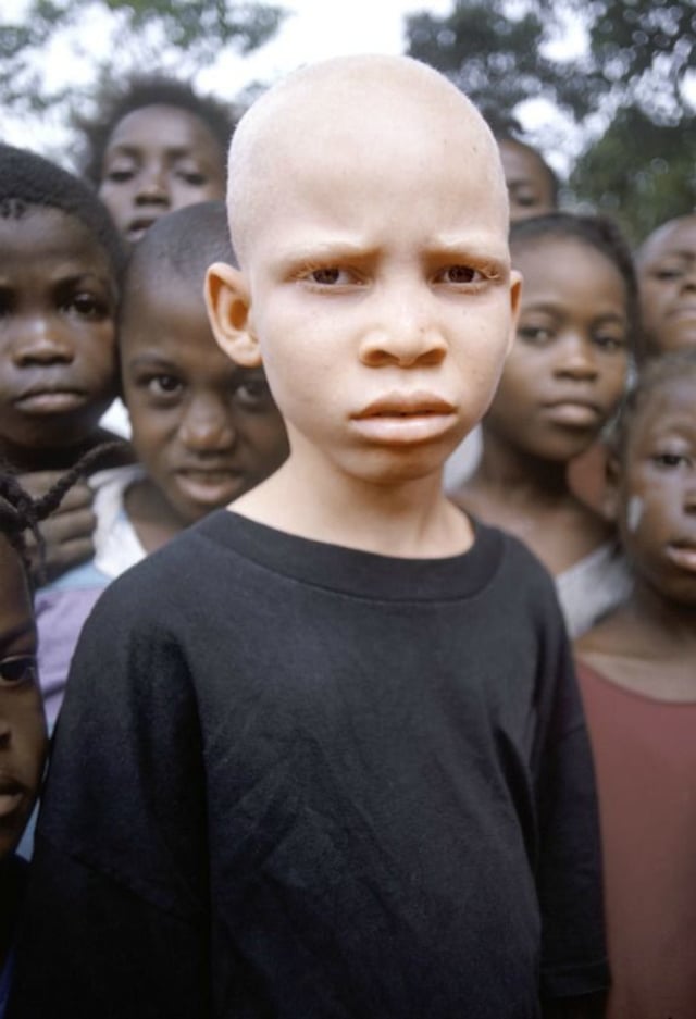 Bocah Afrika yang Albino (Foto: Pinterest)