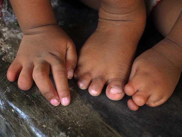 Kondisi saat dalam kandungan (Foto: Larry C. Price/Pulitzer Centre on Crisis Reporting)