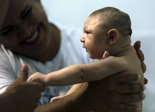 Bayi mikrosefalus yang diduga akibat virus Zika. (Foto: Reuters)