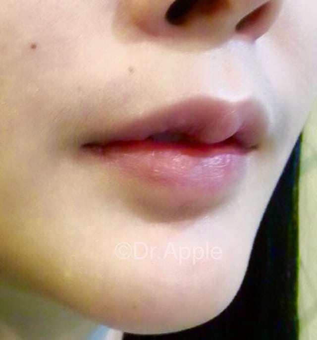 Operasi Plastik Bibir. (Foto: Facebook Dr.Apple Cosmetic Surgery)