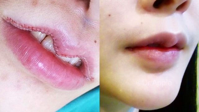 Operasi Plastik Bibir (Foto: Facebook Dr.Apple Cosmetic Surgery)