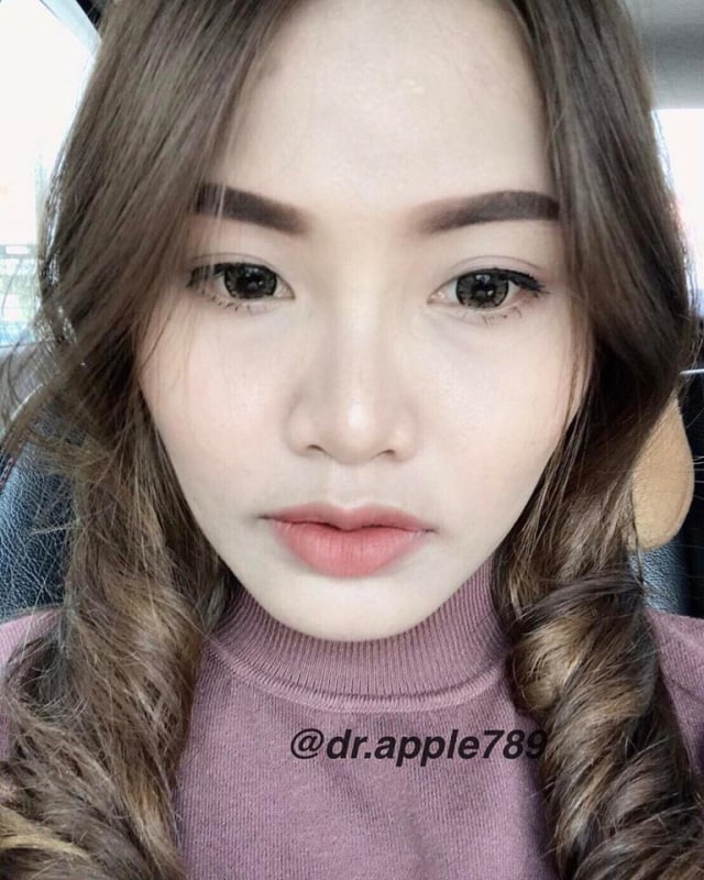 Pasien Operasi Plastik Bibir. (Foto: Facebook Dr.Apple Cosmetic Surgery)