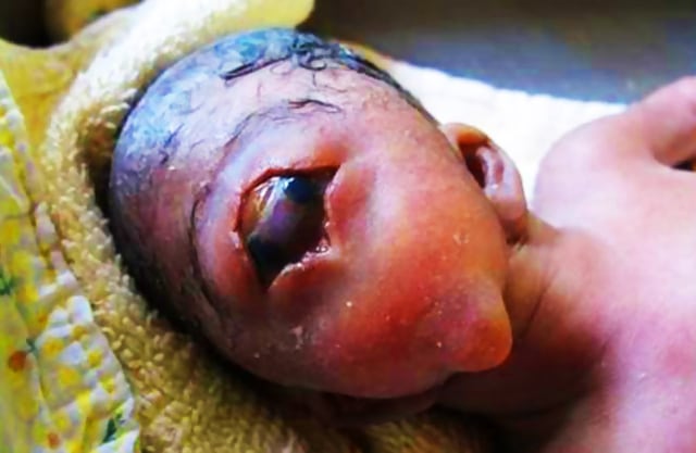 Bayi cyclops syndrome. (Foto: Medical King - Educational Case Studies/Youtube)