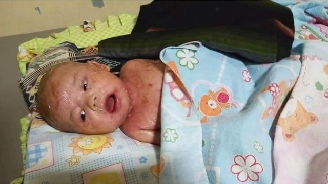 Muhammad Dzaky, bayi yang mengidap collodion baby. (Foto: Instagram @makassar_info)