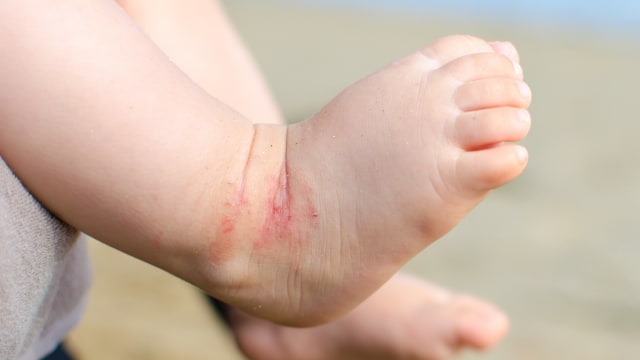 Ilustrasi bayi sakit kulit (Foto: Thinkstock)