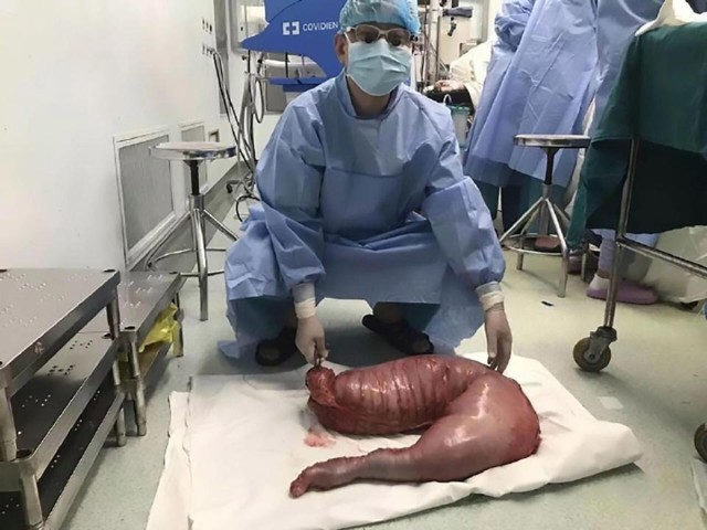 Usus Zhou Hai setelah dioperasi (Foto:  Dokumentasi Shanghai Tenth People's Hospital)
