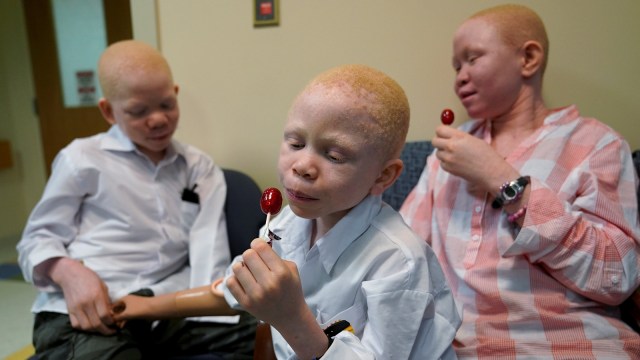 Albino di Tanzania. (Foto: REUTERS/Carlo Allegri)