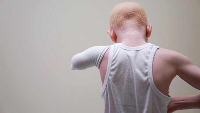 Albino di Tanzania. (Foto: REUTERS/Carlo Allegri)