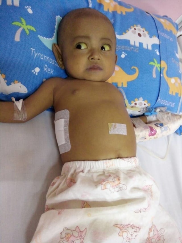 Mishalova, Bayi Penderita Atresia Biller (Foto: Dok. Hanindya)