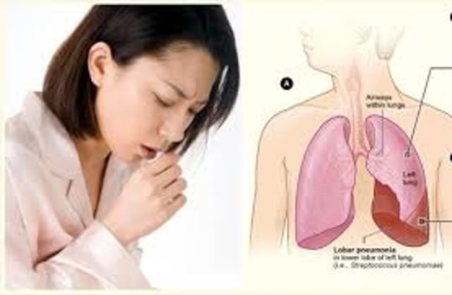 Obat TBC Paru Kronis Yang Ampuh Dan Tanpa Efek Samping