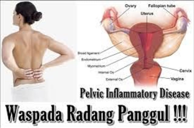 Solusi Untuk Infeksi / Radang Panggul