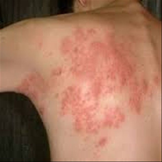 Penyebab gatal pada kulit yang tak kunjung sembuh