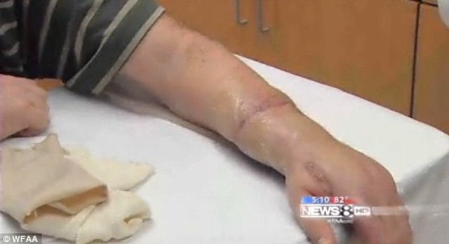 Menyambungkan Lengan Atau Kaki Putus