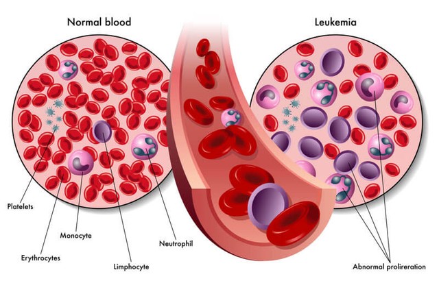 6 Makanan Sehat Untuk Penderita Leukimia Kumparan Com