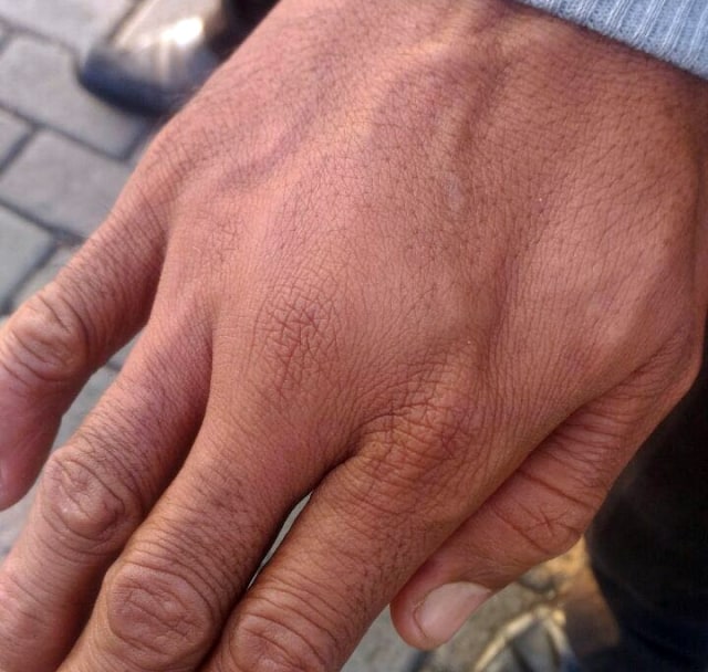 Tangan Sukri yang bengkak (Foto: Humas AP II)