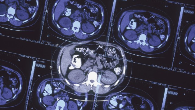 Hasil rontgen MRI  (Foto: Thinkstock)