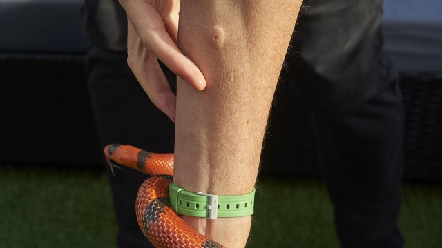 Luka di tangan Ludwin usai injeksi bisa ular (Foto: NIKLAS HALLE'N / AFP)