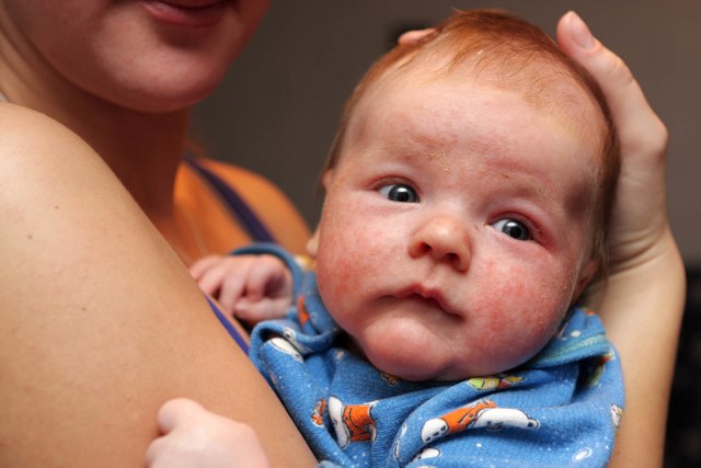 Efek dari alergi makanan pada bayi (Foto: Thinkstock)