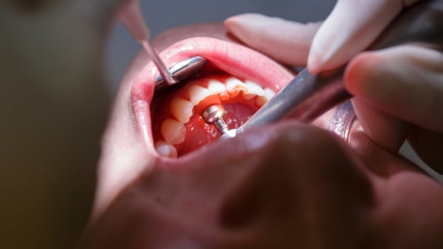 Perawatan gigi (Foto: Thinkstock)