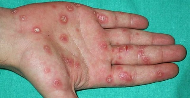 Inilah Ciri Ciri Orang Yang Terkena Penyakit Menular Sipilis | kumparan.com