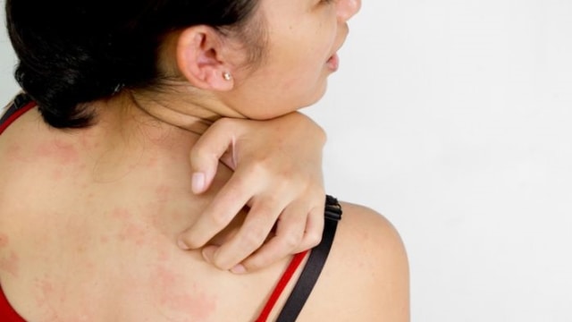 Alergi akibat kosmetik (Foto: Pixabay)