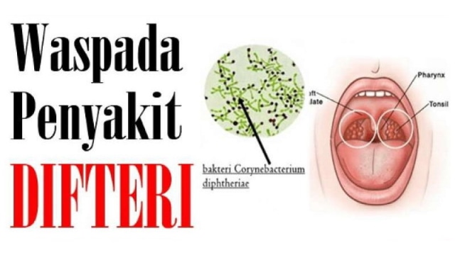Bojonegoro Ditetapkan KLB Kasus Penyakit Difteri