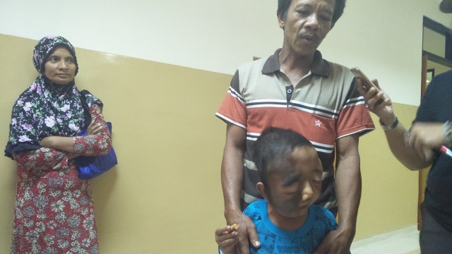 Anak 11 Tahun Idap Penyakit Langka Di Medan (Foto: Ade Nurhaliza/kumparan)