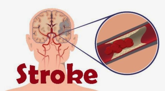 5 Cara Hindari Gejala Stroke di Usia Muda