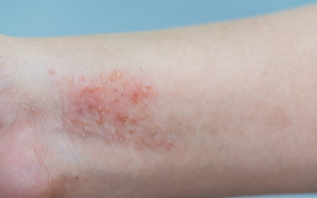 Atopic dermatitis (Foto: Thinkstock)