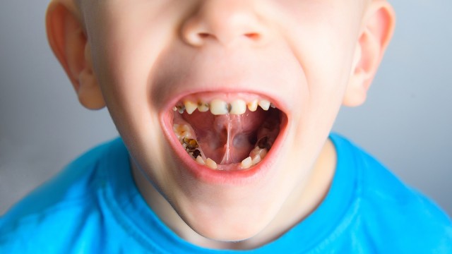 Kesehatan gigi anak  (Foto: Thinkstock)