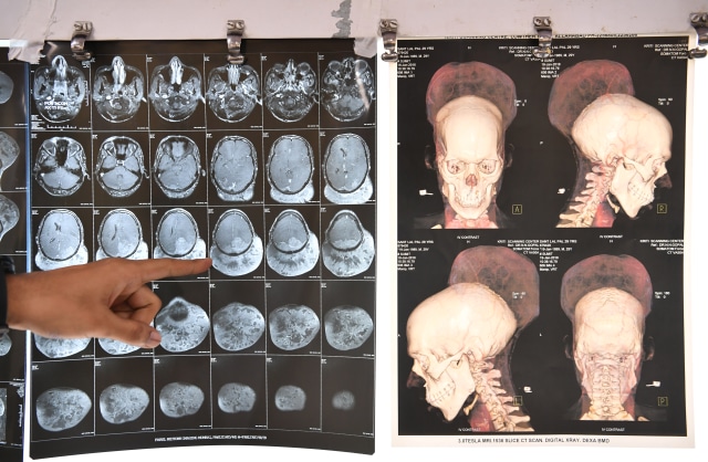 Tumor otak Santlal Pal (Foto: Indranil Mukherjee/AFP)
