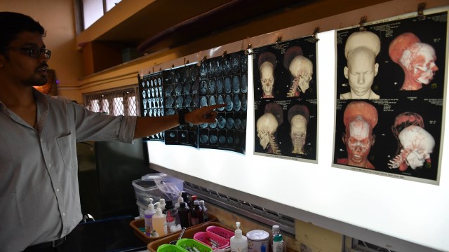 Tumor otak Santlal Pal (Foto: Indranil Mukherjee/AFP)
