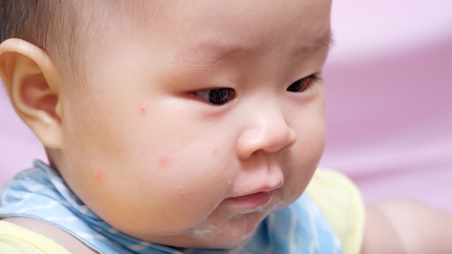Gigitan nyamuk pada anak. (Foto: Thinkstock)