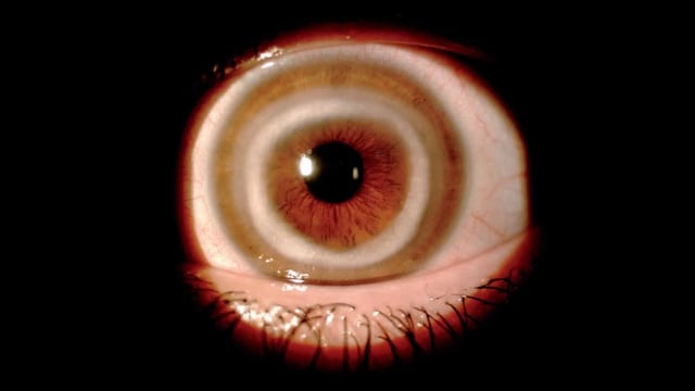 Lingkaran putih aneh di mata wanita Portugal. (Foto: The New England Journal of Medicine)