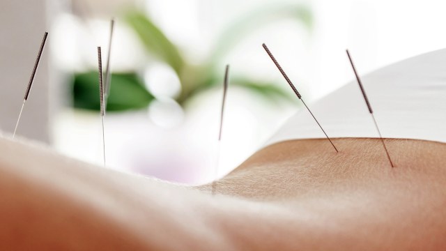 Akupuntur Akupunktur