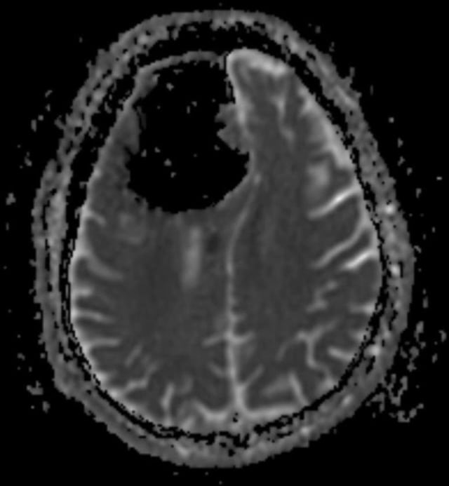 Hasil pindai MRI pria dengan pneumatocoele. (Foto: BMJ Case Reports)