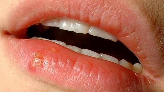 Oral herpes, herpes yang terjadi di mulut (Foto: Metju12 via Wikimedia Commons)