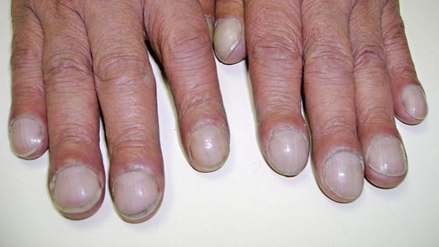Clubbed nails. (Foto: Desherinka via Wikimedia Commons)