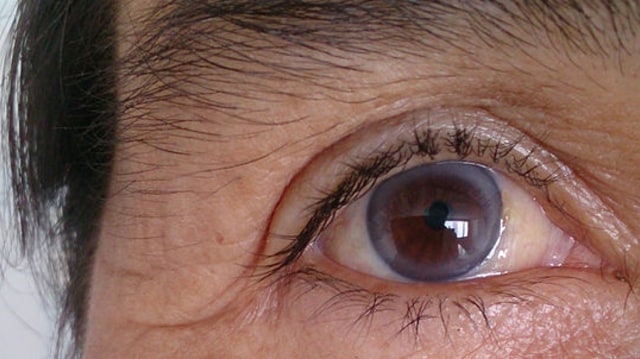 Arcus senilis, lingkaran abu-abu pada mata. (Foto: Afrodriguezg via wikimedia commons)
