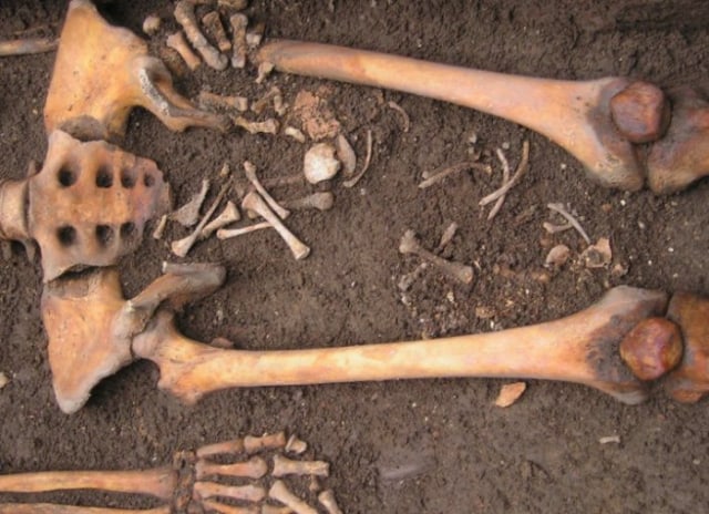 Tulang-tulang bukti kejadian 'beranak dalam kubur' (Foto: Pasini et al./World Neurosurgery)