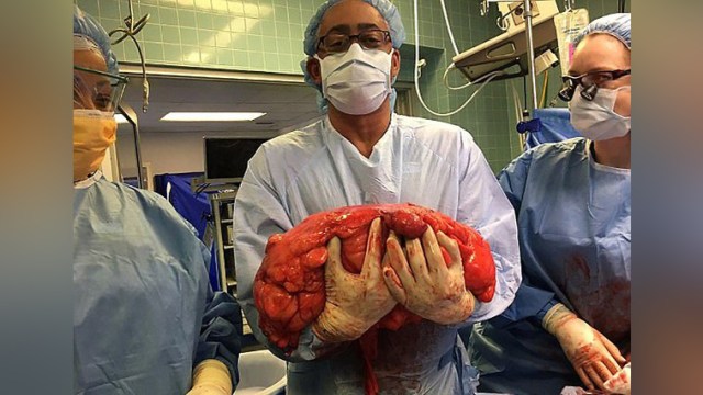 Tumor 13,6 kilogram di perut Kevin Daly (Foto: Dok. Lenox Hill Hospital)