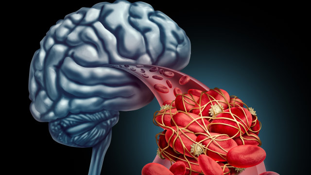 Ilustrasi penyumbatan darah di otak. (Foto: Thinkstock)