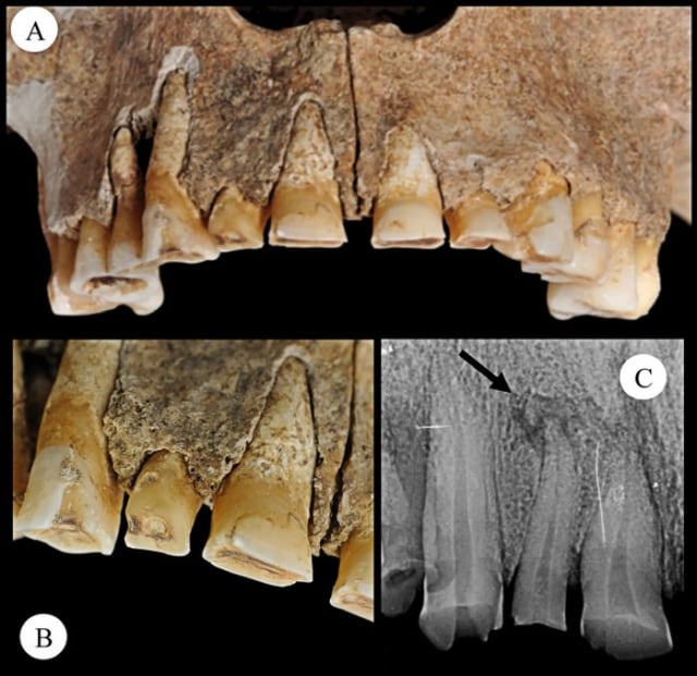 Tulang gigi. (Foto: Micarelli et al./Journal of Anthropological Sciences)