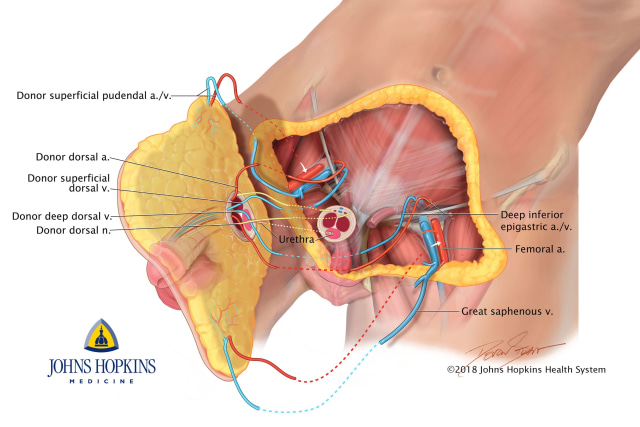 Diagram transplantasi penis. (Foto: Devon Stuart via Johns Hopkins Medicine)