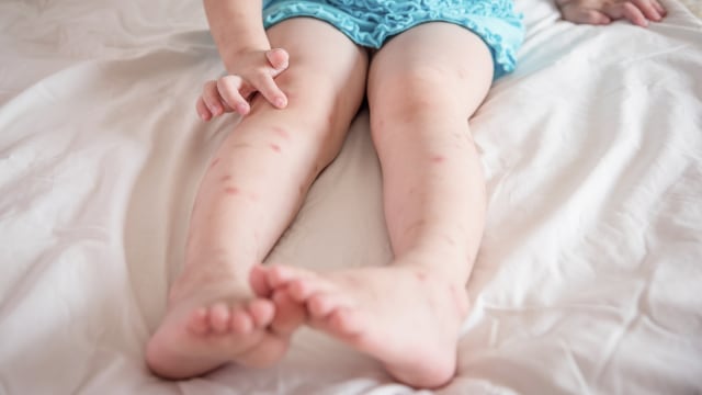 Gatal-gatal hingga Peradangan Kulit, Tanda Bayi Alergi Detergen (44887)