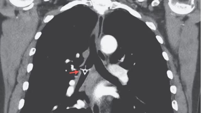 Tulang ayam nyangkut di paru-paru. (Foto: The New England Journal of Medicine)