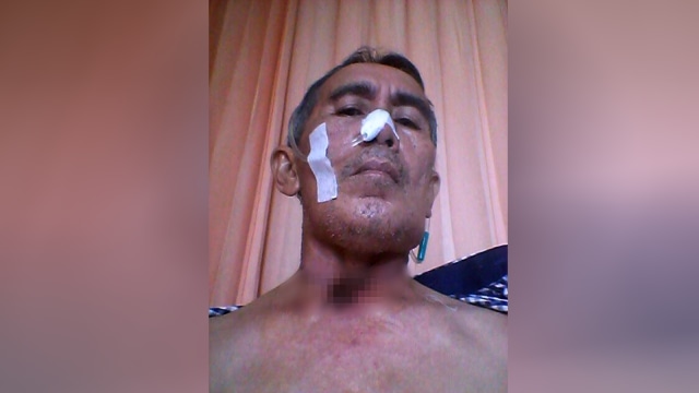 Zainal, Perokok aktif yang terkena Kanker Laring (Foto: Dok. Zainul Abidin)