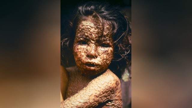 Anak penderita smallpox atau cacar. (Foto: Wikimedia Commons)