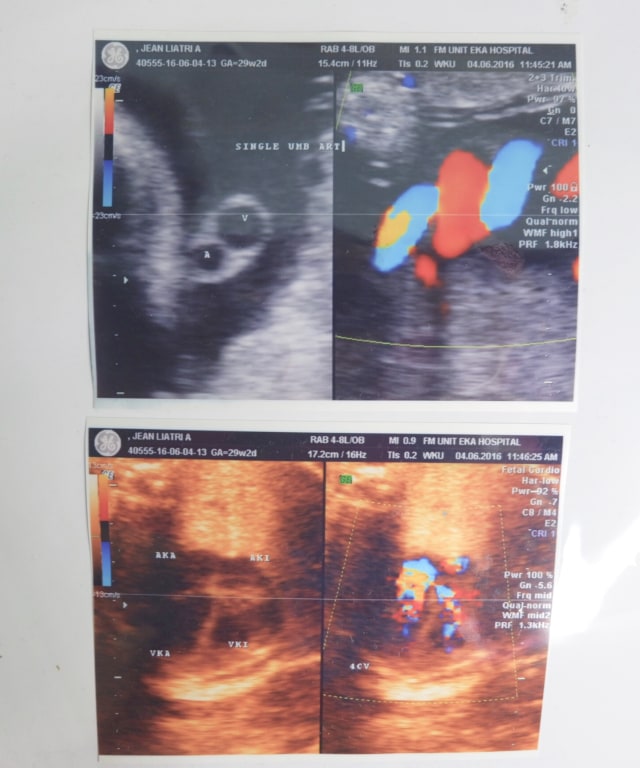 Abnormalitas pada Tali Pusat Single Umbilical Artery (2)