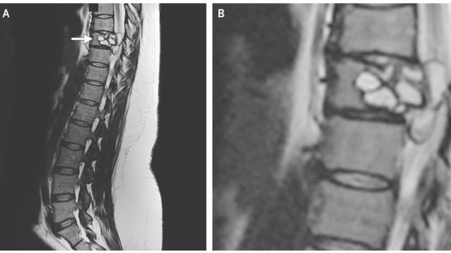 Parasit di tulang belakang perempuan. (Foto: The New England Journal of Medicine.)